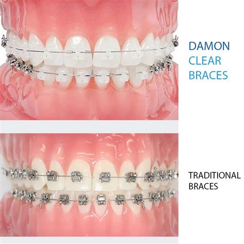 bracket damon metal|are damon braces more expensive.